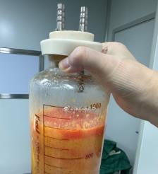 丽水水动力吸脂手术要做多久？